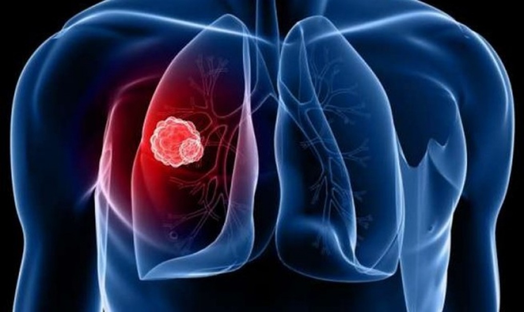 Туберкульоз