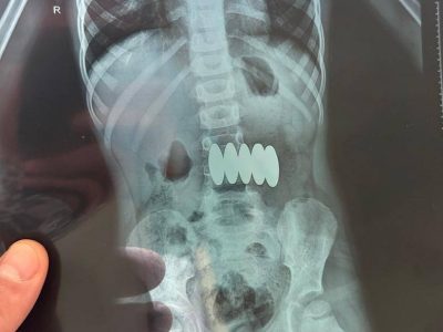 магніти у дитині