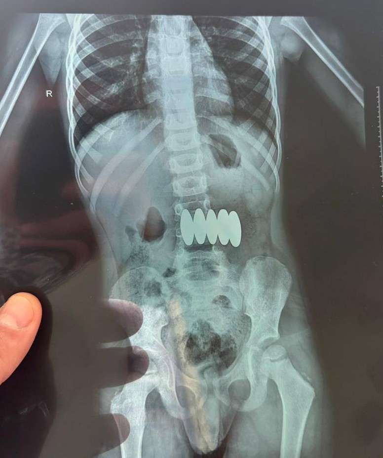 У Черкасах дитина проковтнула п’ять магнітів (ФОТО, ВІДЕО)